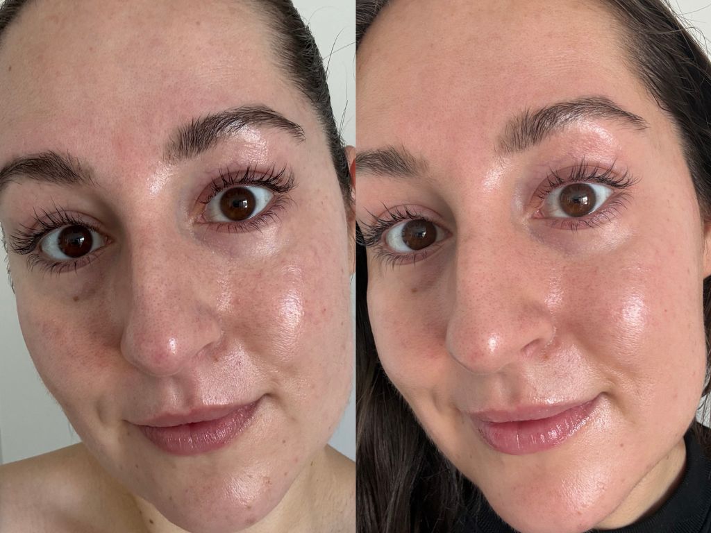 Yasmin's skin journey Yasmin's skin journey